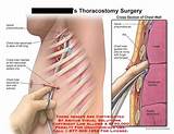 Images of Tube Thoracostomy Procedure