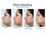 Dermapen Micro Needling Treatment Of Acne Scars Photos