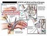 Images of Thumb Arthroplasty Recovery