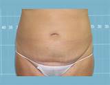 Images of Fat Freezing Treatment Prices