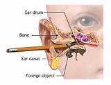 Can Water Damage Your Ear