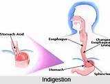 Symptoms Of Indigestion And Gas