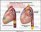 Intra Aortic Balloon Pump Images