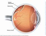 Treatment For Hole In Retina Of Eye Pictures