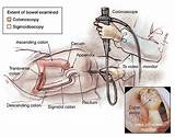 How Do Doctors Do A Colonoscopy