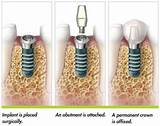 Photos of Permanent Dental Implants Procedure