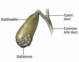 Gallbladder Malpractice Lawyer Images