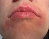 Allergic Reaction Swollen Tongue Treatment Photos