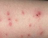 Pictures of Bed Bug Treatment For Skin