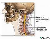 Cervical Spine Disc Bulge Treatment Pictures