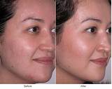 Photos of Aggressive Acne Treatment