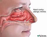 Medication For Nasal Polyps Images