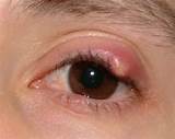 Upper Eyelid Infection Home Remedies Photos