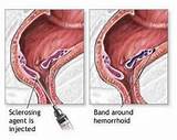 What Will A Doctor Do For Hemorrhoids Images