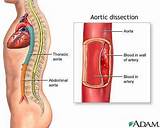 Medical Management Of Aortic Dissection