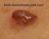 Pictures of How Do Doctors Remove Hemorrhoids