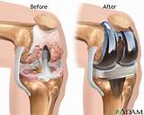 Pictures of Partial Hip Replacement Recovery Time Elderly