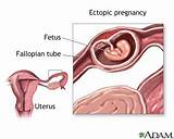 Pictures of Can A Baby Get Stuck In The Fallopian Tube