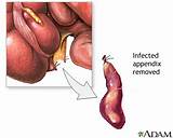 Recovery From Appendix Surgery Laparoscopic Images