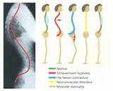 Pictures of Kyphosis Muscle Exercises