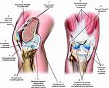 Images of Patellar Clunk Syndrome Treatment