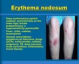 Erythema Nodosum Home Remedies