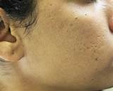 Photos of Treatments For Ice Pick Acne Scars