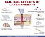 Low Level Laser Therapy Side Effects Pictures