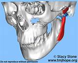 Pictures of Tmj Surgery Recovery Tips