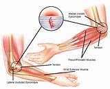 Pictures of Tendonitis Therapy