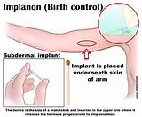 Pictures of Side Effects On Birth Control Implant