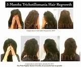 Images of Can Hair Grow Back After Alopecia