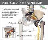 Piriformis Syndrome Home Remedies Photos