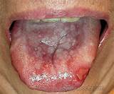 Pictures of Oral Lichen Planus Specialist Doctor