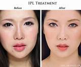Images of Ipl One Treatment