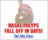 Medication For Nasal Polyps