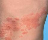 Do I Need To See A Doctor For Shingles Images