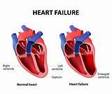 Heart Failure Home Remedies Pictures