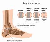 Sprained Ankle Recovery Time Grade 3 Images