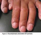 Pictures of Palmar Psoriasis Home Remedies