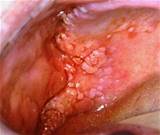 Genital Warts Inside Anus Treatment Images