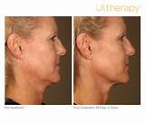 Images of How Much Does Ultherapy Treatment Cost