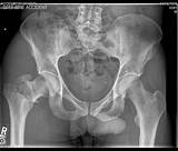 Pelvic Fracture Treatment And Recovery Pictures
