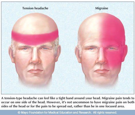 Migraine Headache On Right Side Of Head Photos