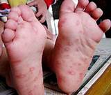 Photos of How Do Doctors Test For Ulcers