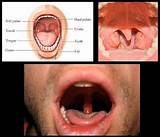 Acid Reflux Sore Throat Treatment Photos