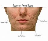 Pictures of Treatments For Ice Pick Acne Scars