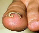 Ingrown Toenail Surgery Recovery Pictures