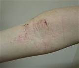 Eczema In Elbow Crease Treatment Photos