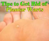 Seed Wart Removal Home Remedies Pictures